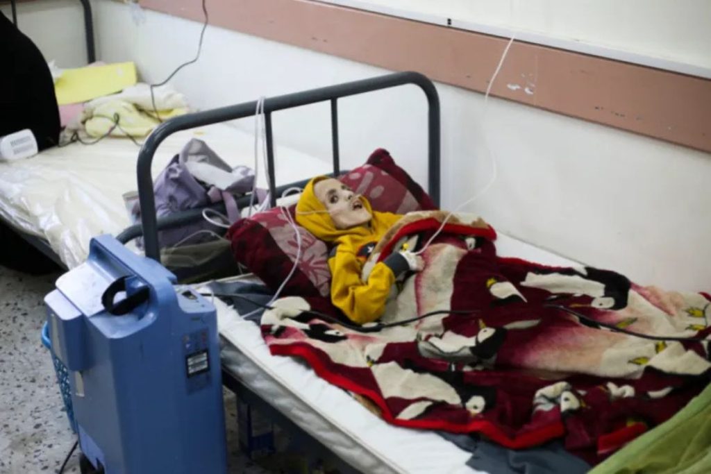 Yazan al-Kafarna yang berusia sepuluh tahun, terlahir dengan kelumpuhan otak, terbaring di sebuah rumah sakit di Rafah, pada 3 Maret 2024. Yazan meninggal karena penyusutan otot yang ekstrem yang disebabkan terutama oleh kurangnya makanan