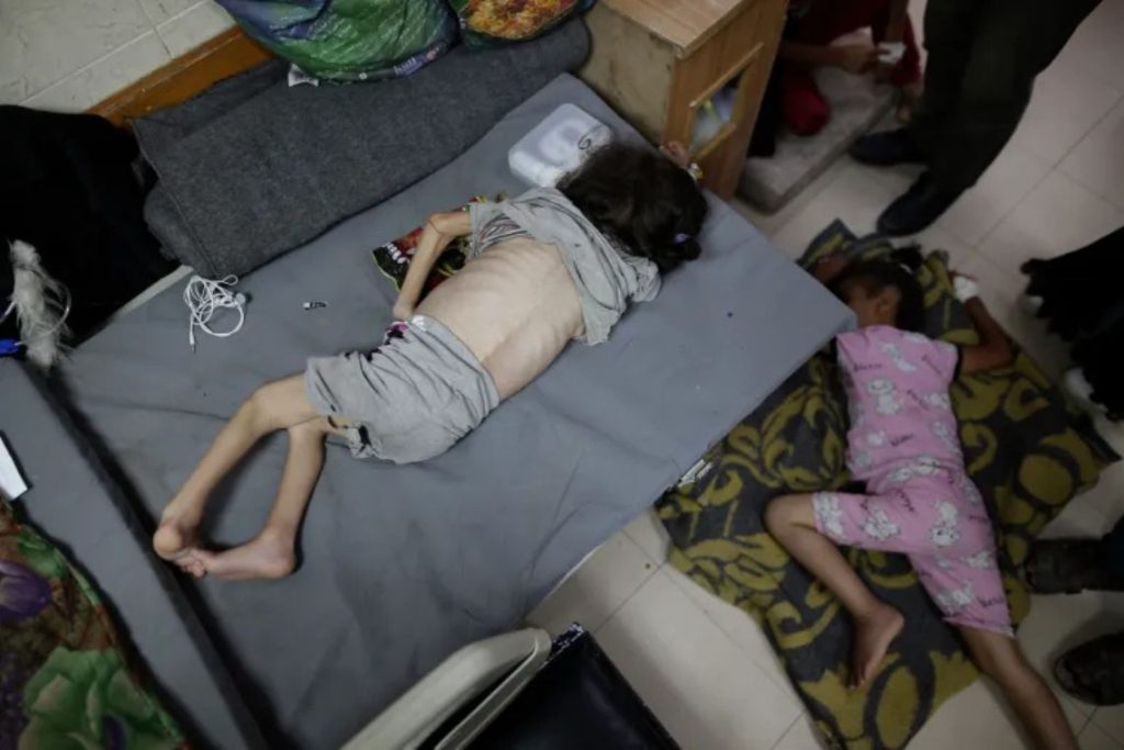 Seorang anak berusia tiga tahun yang menderita diabetes, sistem kekebalan tubuh yang lemah dan malnutrisi, beristirahat di Rumah Sakit