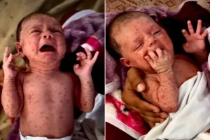 Wabah Cacar Air Mengancam Anak-Anak Gaza: Ribuan Kasus Muncul di Tengah Kamp Pengungsian